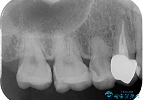 欠けてしまった奥歯 セラミッククラウンとセラミックインレーによるむし歯治療の治療前