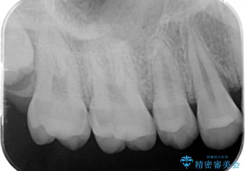 歯と歯の間の虫歯 e-maxインレーで修復の治療前