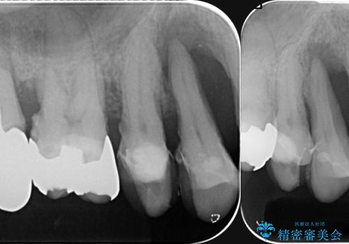 インプラント・ブリッジ補綴を含む、歯周病全顎治療の治療前