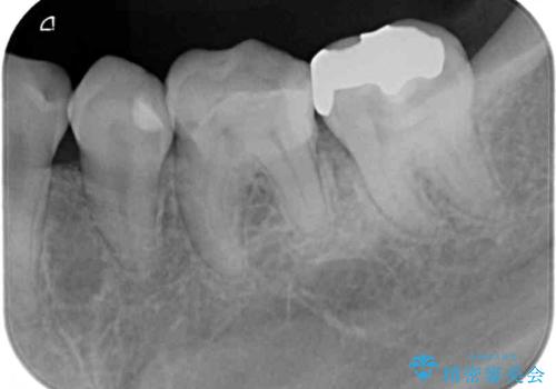 欠けてしまった奥歯 セラミッククラウンとセラミックインレーによるむし歯治療の治療前