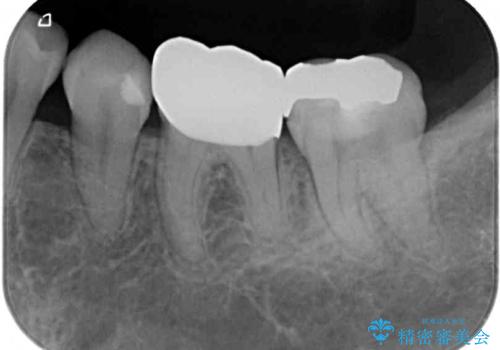 欠けてしまった奥歯 セラミッククラウンとセラミックインレーによるむし歯治療の治療後