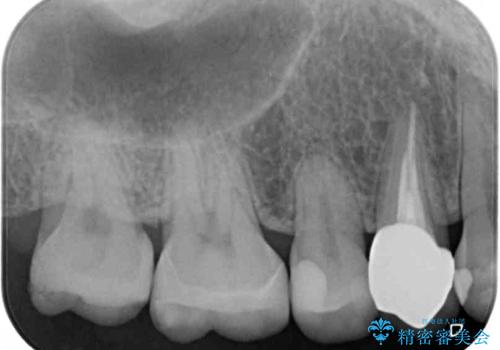 欠けてしまった奥歯 セラミッククラウンとセラミックインレーによるむし歯治療の治療後