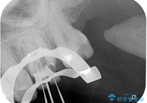 境目にものが詰まって気になる オールセラミッククラウン治療の治療中