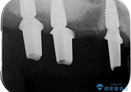 インプラント・ブリッジ補綴を含む、歯周病全顎治療の治療中