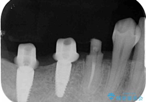 インプラント・ブリッジ補綴を含む、歯周病全顎治療の治療中