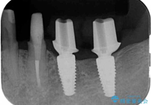 インプラント・ブリッジ補綴を含む、歯周病全顎治療の治療中