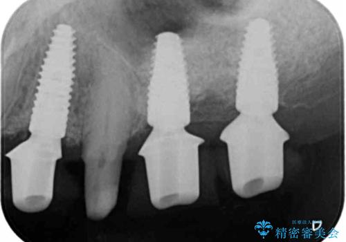インプラント・ブリッジ補綴を含む、歯周病全顎治療の治療中