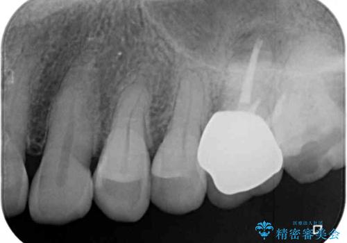 境目にものが詰まって気になる オールセラミッククラウン治療の治療後