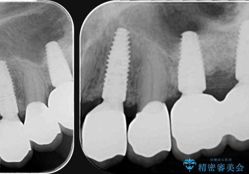 インプラント・ブリッジ補綴を含む、歯周病全顎治療の治療後