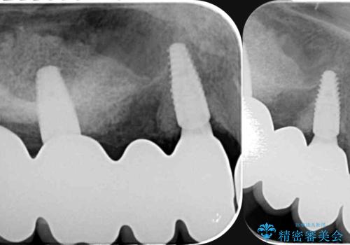 インプラント・ブリッジ補綴を含む、歯周病全顎治療の治療後