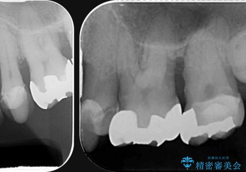 インプラント・ブリッジ補綴を含む、歯周病全顎治療の治療前