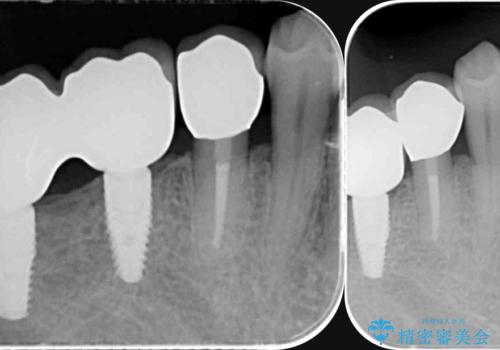 インプラント・ブリッジ補綴を含む、歯周病全顎治療の治療後