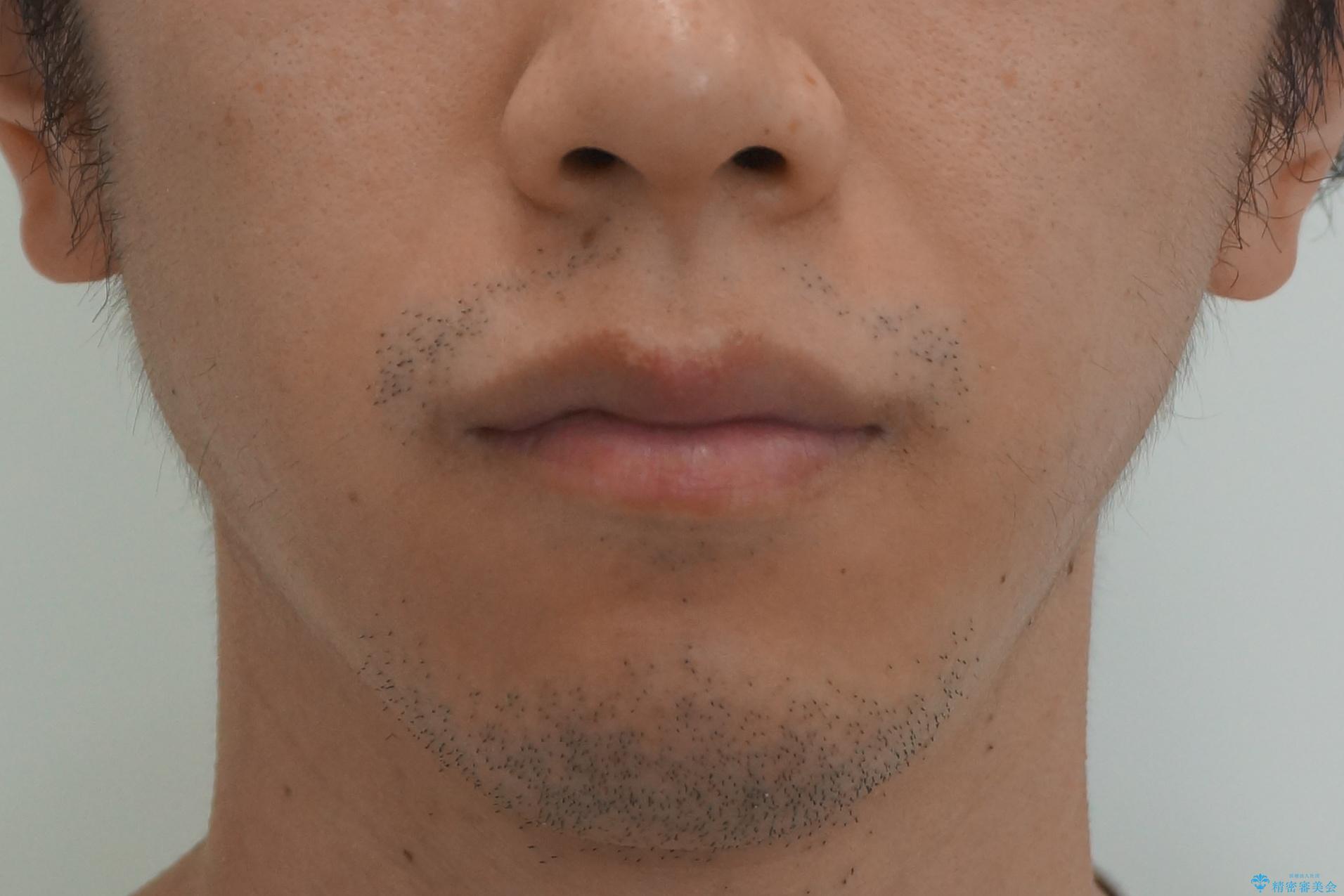 出っ歯をしっかり引っ込めたいの治療前(顔貌)