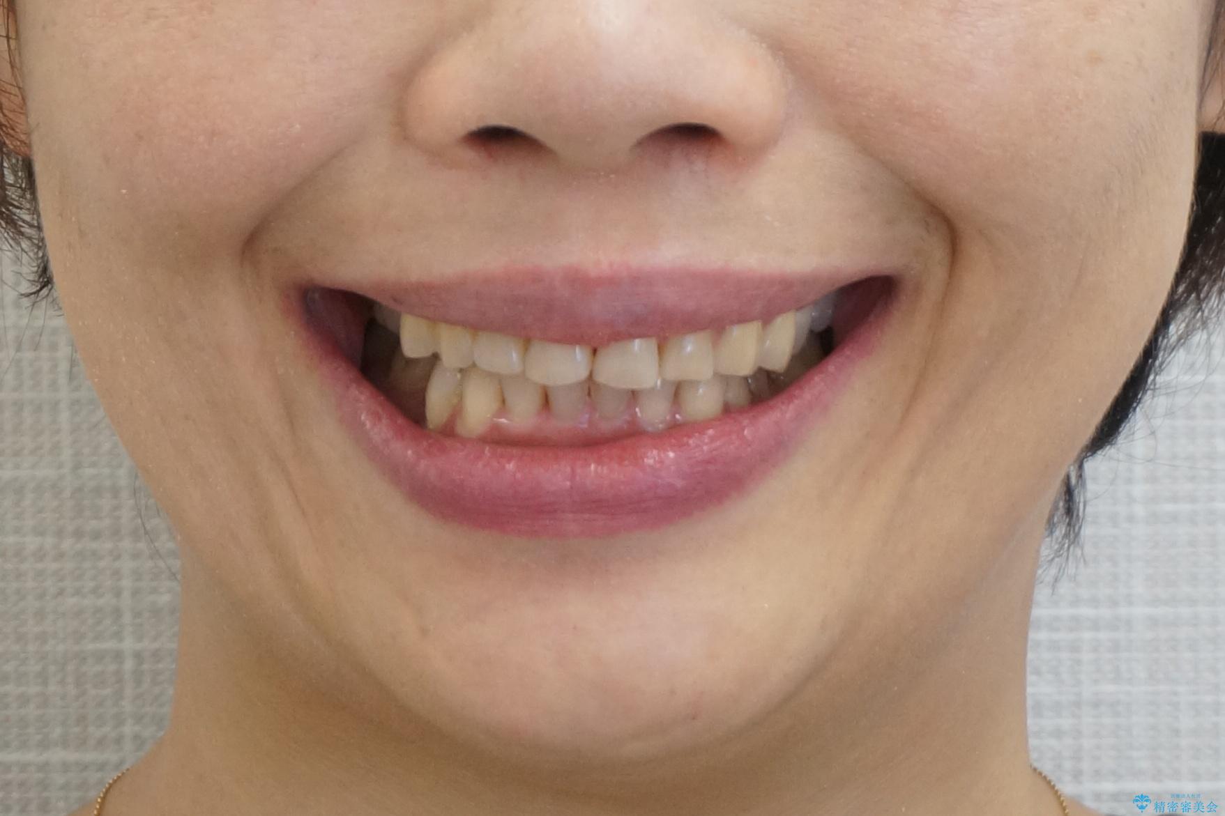 50代女性　部分矯正で　前歯の見た目改善　気になるところだけの治療後（顔貌）