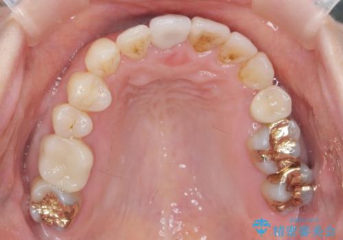 ナイトガードで就寝時の歯の予防の治療前