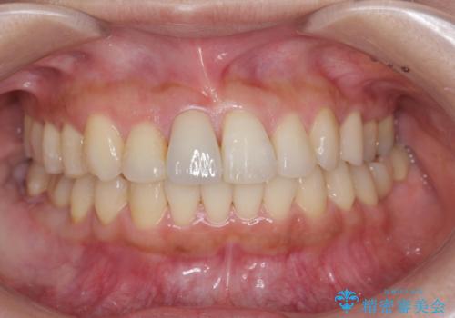 ナイトガードで就寝時の歯の予防の症例 治療前