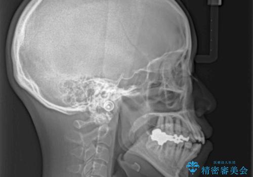 出っ歯と奥歯の欠損 ワイヤー矯正とインプラント治療の治療前