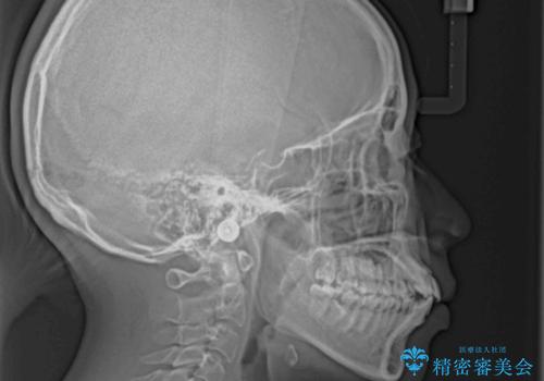 くちばしのような前歯が気になる ワイヤー装置による抜歯矯正治療の治療前