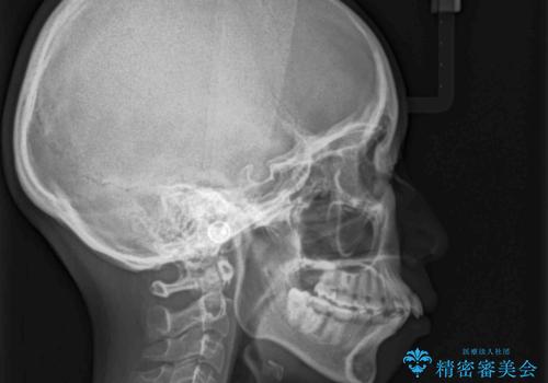 目立たない裏側装置 ハーフリンガルの抜歯矯正の治療前