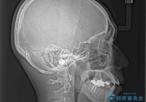 八重歯と開咬 ワイヤー装置での抜歯矯正の治療前