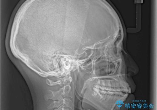 気がつくと唇が開く 口元を下げる抜歯矯正の治療前