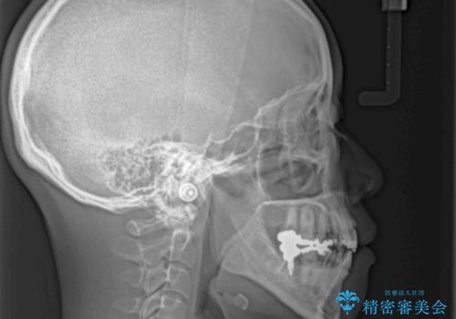 出っ歯と奥歯の欠損 ワイヤー矯正とインプラント治療の治療後