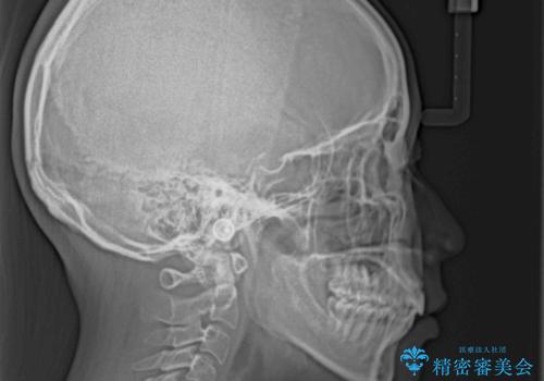 くちばしのような前歯が気になる ワイヤー装置による抜歯矯正治療の治療後