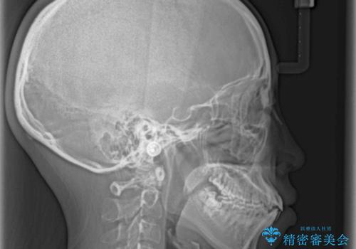 口が閉じられない ワイヤー装置による矯正治療の治療前