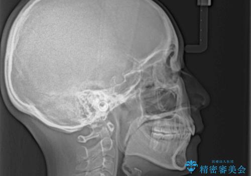 目立たない裏側装置 ハーフリンガルの抜歯矯正の治療後