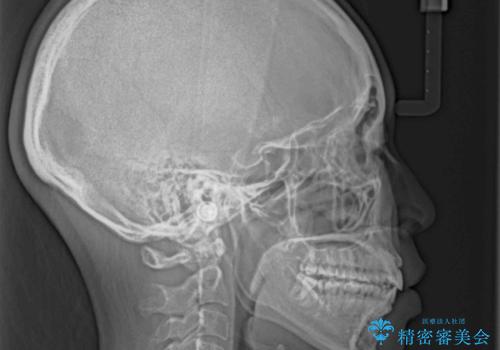 気がつくと唇が開く 口元を下げる抜歯矯正の治療後