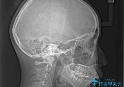 尖った前歯を引っ込めたい 目立たないワイヤー装置での抜歯矯正の治療前