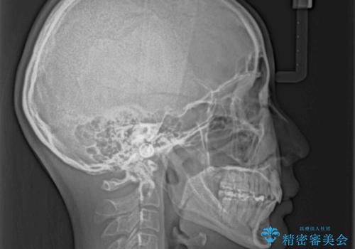 尖った前歯を引っ込めたい 目立たないワイヤー装置での抜歯矯正の治療後
