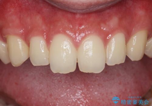 ナイトガードで歯の予防をしたい。の治療前