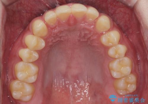 ナイトガードで歯の予防をしたい。の治療前