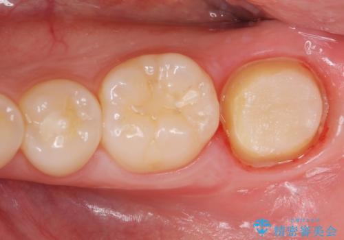 他院での治療に不信感 虫歯除去後のジルコニアクラウンの治療中