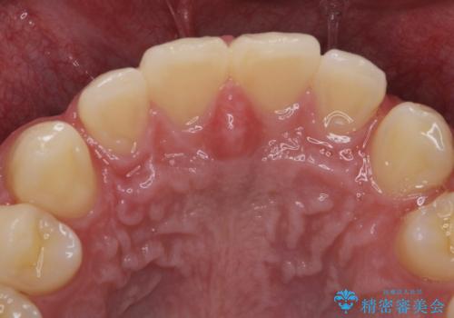 ナイトガードで歯の予防をしたい。の治療前