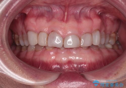 前歯の変色と隙間を治したい　前歯の審美歯科治療の症例 治療前