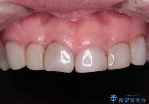前歯の変色と隙間を治したい 前歯の審美歯科治療の治療前