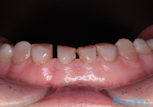 前歯の変色と隙間を治したい　前歯の審美歯科治療