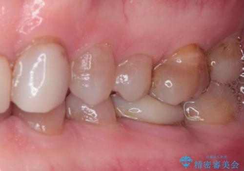 前歯の変色と隙間を治したい 前歯の審美歯科治療の治療前