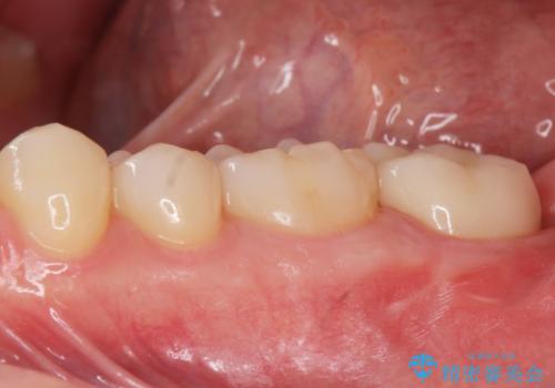 他院での治療に不信感 虫歯除去後のジルコニアクラウンの治療後