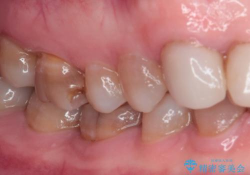 前歯の変色と隙間を治したい　前歯の審美歯科治療の治療前