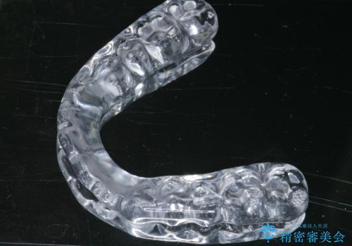 ナイトガードで歯の予防をしたい。の治療中