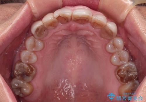 前歯の変色と隙間を治したい 前歯の審美歯科治療の治療前