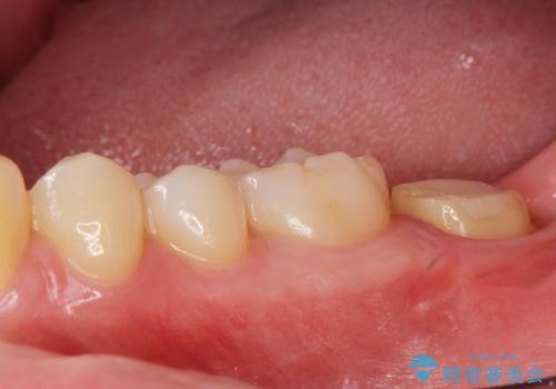 他院での治療に不信感 虫歯除去後のジルコニアクラウンの治療中