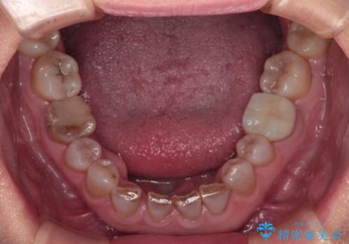 前歯の変色と隙間を治したい 前歯の審美歯科治療の治療前