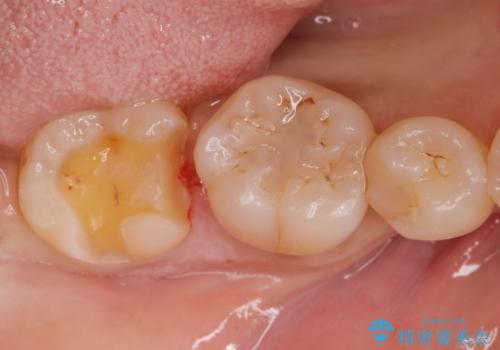 歯に食べ物が詰まる。の治療中