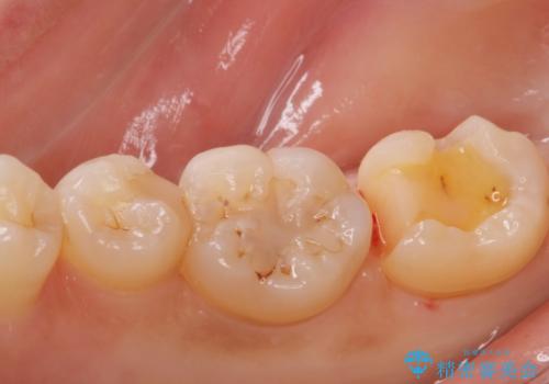 歯に食べ物が詰まる。の治療中