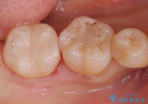歯に食べ物が詰まる。の治療後