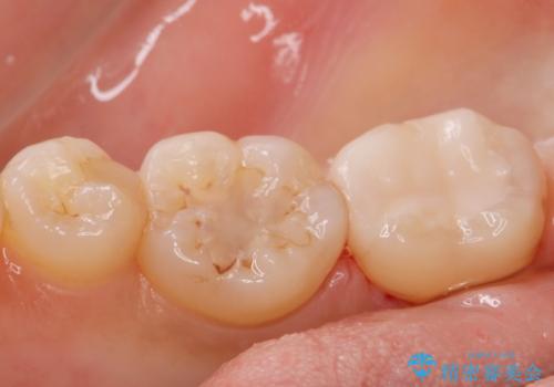 歯に食べ物が詰まる。の治療後